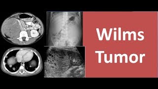 Wilms Tumor [upl. by Smail]