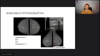 Лучевая диагностика молочных желез [upl. by Natye]