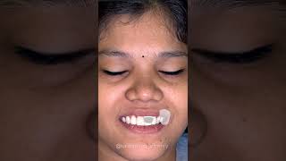 Before amp After  Fix Gap in Teeth  Cosmetic Dentistry  Dr Charishma  Nihiras Dental Care  Vizag [upl. by Naicad]