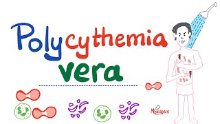 Polycythemia Vera PV  Myeloproliferative Neoplasm MPN  Erythrocytosis  Hematology [upl. by Gentille]