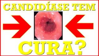 🔴 Candidíase tem Cura Conheça os Sintomas Tratamento Como Evitar e Tratar [upl. by Eire429]