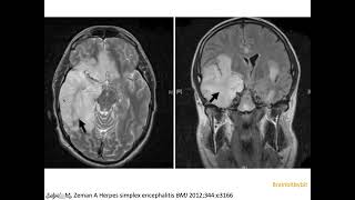 17 Limbic encephalitis antiNMDA paraneoplastic herpes encephalitis HSV1 HHV6 MRI [upl. by Shih948]