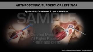 Arthroscopic Surgery of Left TMJ [upl. by Wyn]