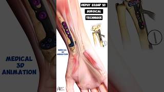 Depuy S3SNP 10 Surgical Technique Medical 3D Animation short biology With Aliya [upl. by Anwahsed]