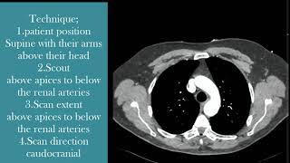 CT angiography of the chest technique [upl. by Rtoip]