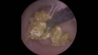 Endoscopic Ear Wax Removal Leicester  Mr Neel Raithatha The Hear Clinic [upl. by Attelrac]