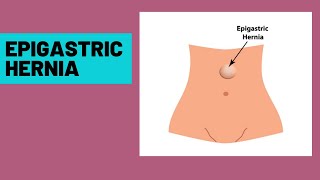 Epigastric hernia  symptoms clinical features [upl. by Massingill488]