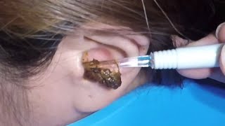 The Most Massive Earwax Removed in One Scoop [upl. by Palmore]