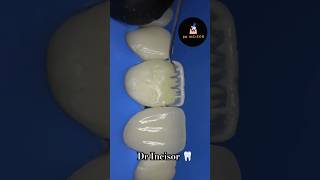 Dr Incisor Dentine layering dental dentist dentistry smile teeth dentalcare dentalclinic [upl. by Alleul]