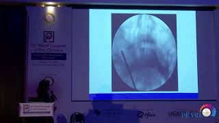 Percutaneous Interventions on Sphenopalatine and Gasserian Ganglion for Orofacial Pain [upl. by Wandy]