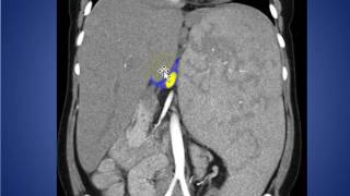 RADIOLOGY ROUNDS 036 SPLENOMEGALY [upl. by Lebasiairam]