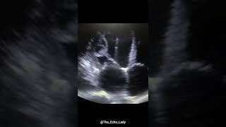 What is this 🙃 echocardiogram cardiology echocardiography [upl. by Sieber]