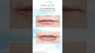 Why Hyaluronic Acid Fillers are Safer than PermanentSemiPermanent Fillers lipfiller [upl. by Anilam]