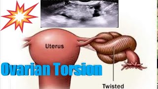 Level 3  Female pelvis  Gyn  Ovary Torsion [upl. by Sprague]