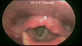 Video Laryngoscopy  Right Vocal cord paralysis following upper respiratory track infection URTI [upl. by Modern883]