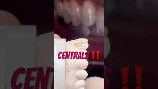 A quickly waxups of the centrals‼️ smilemakeover dentalwax cosmeticdentistry [upl. by Nner]