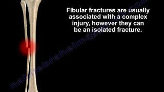 Fibular Fracture isolated Everything You Need To Know  Dr Nabil Ebraheim [upl. by Florrie]