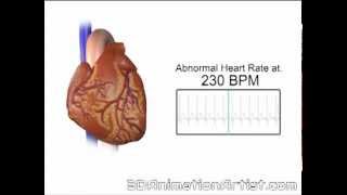 Normal Vs Accelerated Heart Rate [upl. by Lalad]