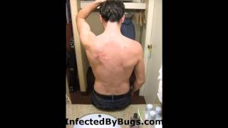 How To Get Rid OF Bed Bugs Yourself  Photos Of Bed Bugs [upl. by Gawen]