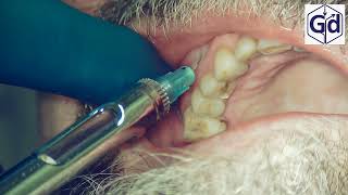 Infiltration Anesthesia for treatment tooth 24 [upl. by Ernst]