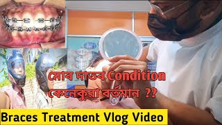 Braces treatment vlog videoমোৰ জাতৰ condition 🙂 [upl. by Tshombe]