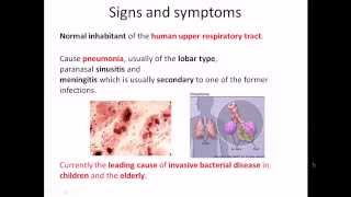 Streptococcus pneumoniae infection and disease [upl. by Ardekahs]