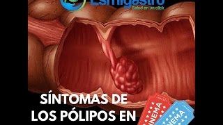 Síntomas de Pólipos en el Colon [upl. by Dolf570]