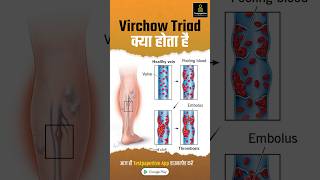 Virchows Triad Nursing Explanation Causes of Venous and Arterial VirchowTriad venous Nursing [upl. by Nylsor531]