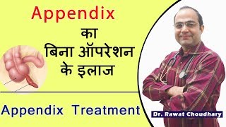 Best treatment of Appendix without operation  Appendicitis Best Treatment  अपेंडिक्स का इलाज [upl. by Sanalda]