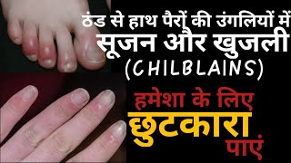 सर्दी में हाथों पैरों की उंगलियों की सूजन दूर करने के घरेलू उपाय  CHILBLAINS [upl. by Abbotsun501]