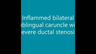 Inflamed Sublingual Caruncle with severe Ductal Stenosis  Dr Nyer Firdoose [upl. by Pavkovic405]