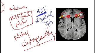 Video 217 Overview of Demyelinating Disorders Clinical Features Diagnostics and Risk Factors [upl. by Fredie592]