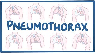 Pneumothorax  causes symptoms diagnosis treatment pathology [upl. by Range773]