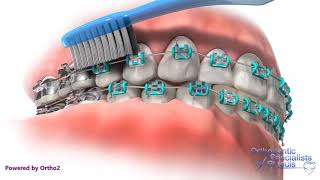 Proper Brushing  Orthodontic Care Instructions [upl. by Lednic93]