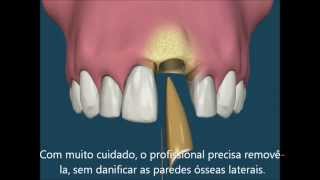 Implante dentário após extração [upl. by Cord329]