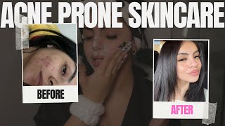 TREATING MY ACNE  skin carehair care [upl. by Pryce]