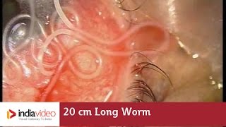 20 cm Long Worm In The Human Eye First Ever Recorded On Video  India Video [upl. by Kremer]