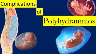 Complications of Polyhydramnios [upl. by Liz]