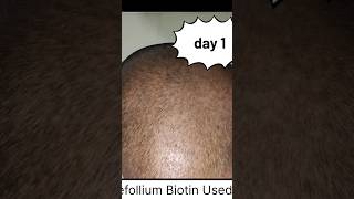 biotin hair growth results before and after  biotin side effect  refollium biotin results  biotin [upl. by Daht]