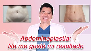 No Quede Conforme Con Mi Abdominoplastia [upl. by Cherilyn354]