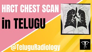 HRCT CHEST SCAN IN TELUGU TeluguRadiology [upl. by Tecu648]