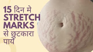 stretch marks क्यों होते हैं कैसे दिखते हैं और stretch marks से छुटकारा कैसे पाए [upl. by Henriha83]