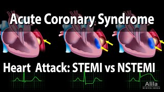 Acute Coronary Syndrome Unstable Angina NSTEMI and STEMI Heart Attack Animation [upl. by Aiekam]