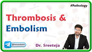 13 Thrombosis And Embolism  USMLE Step 1 Pathology [upl. by Yirinec]