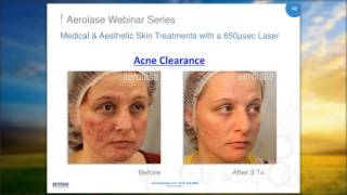 Medical amp Aesthetic Skin Treatments with a 650µsec Laser [upl. by Niklaus547]