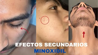 EFECTOS SECUNDARIOS AL USAR MINOXIDIL BARBA [upl. by Onitram]