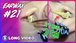 EP 21 Earwax ASMR Remove earwax to hear the world talk more clearly in full HD mode [upl. by Gottlieb]