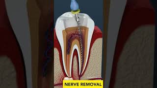 Tooth Cavity amp Root Canal [upl. by Naitsyrk]