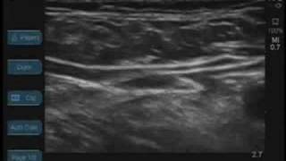 Femoral Nerve Ultrasound [upl. by Nelo]