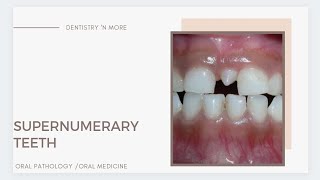 SUPERNUMERARY TEETH [upl. by Gundry]